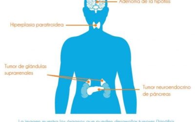 Tumores Neuroendocrinos